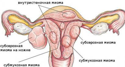 गर्भाशय फाइब्रॉएड - यह क्या है, कारण, पहले संकेत, लक्षण, उपचार और जटिलताएं गर्भाशय फाइब्रॉएड के लक्षण और संकेत उपचार