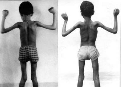 Duchennova svalová dystrofia: príčiny a symptómy ochorenia liečba Duchennovou dystrofiou