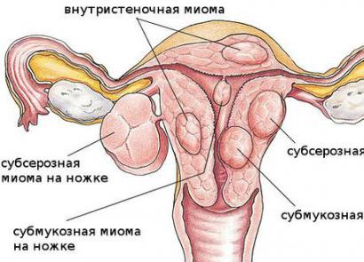 Fibroid rahim - apa itu, penyebab, tanda pertama, gejala, pengobatan dan komplikasi Gejala dan tanda pengobatan fibroid rahim